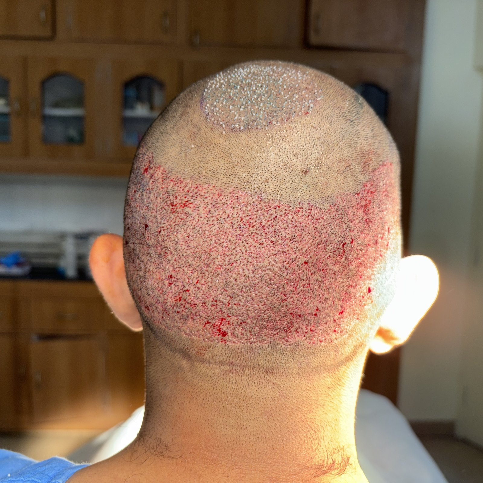 best treatment for hair transplant